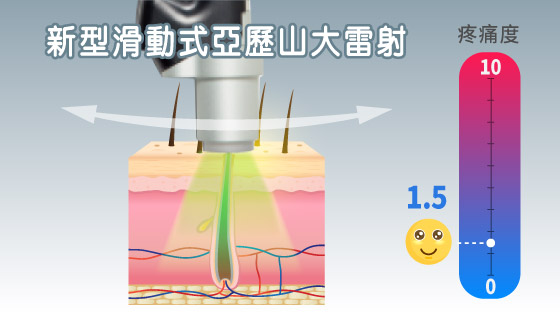 新型滑動式亞歷山大雷射