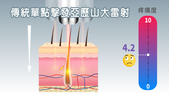 傳統定點式亞歷山大雷射